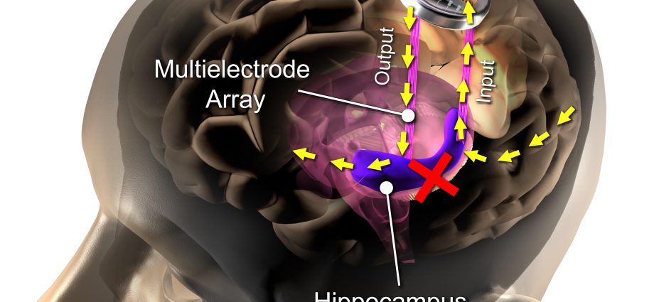 An implant in the brain that will help you recover your memory. The latest discovery of scientists