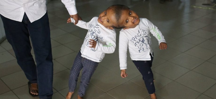 An innovative operation to separate Siamese twins successfully completed