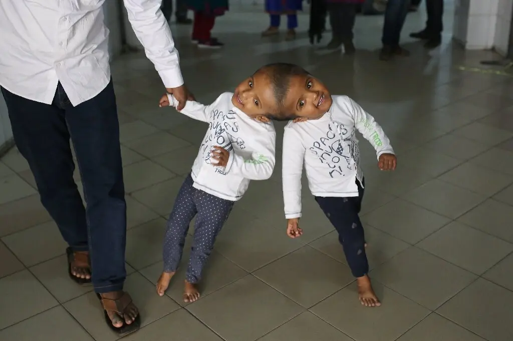 An innovative operation to separate Siamese twins successfully completed