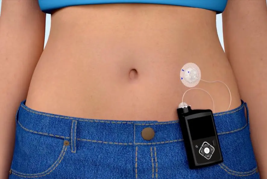 An insulin pump &#8211; what it is and when it is used