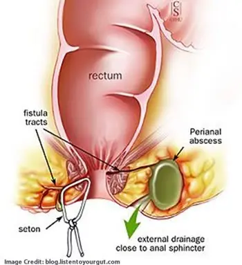 Anal abscess &#8211; what is the treatment like?