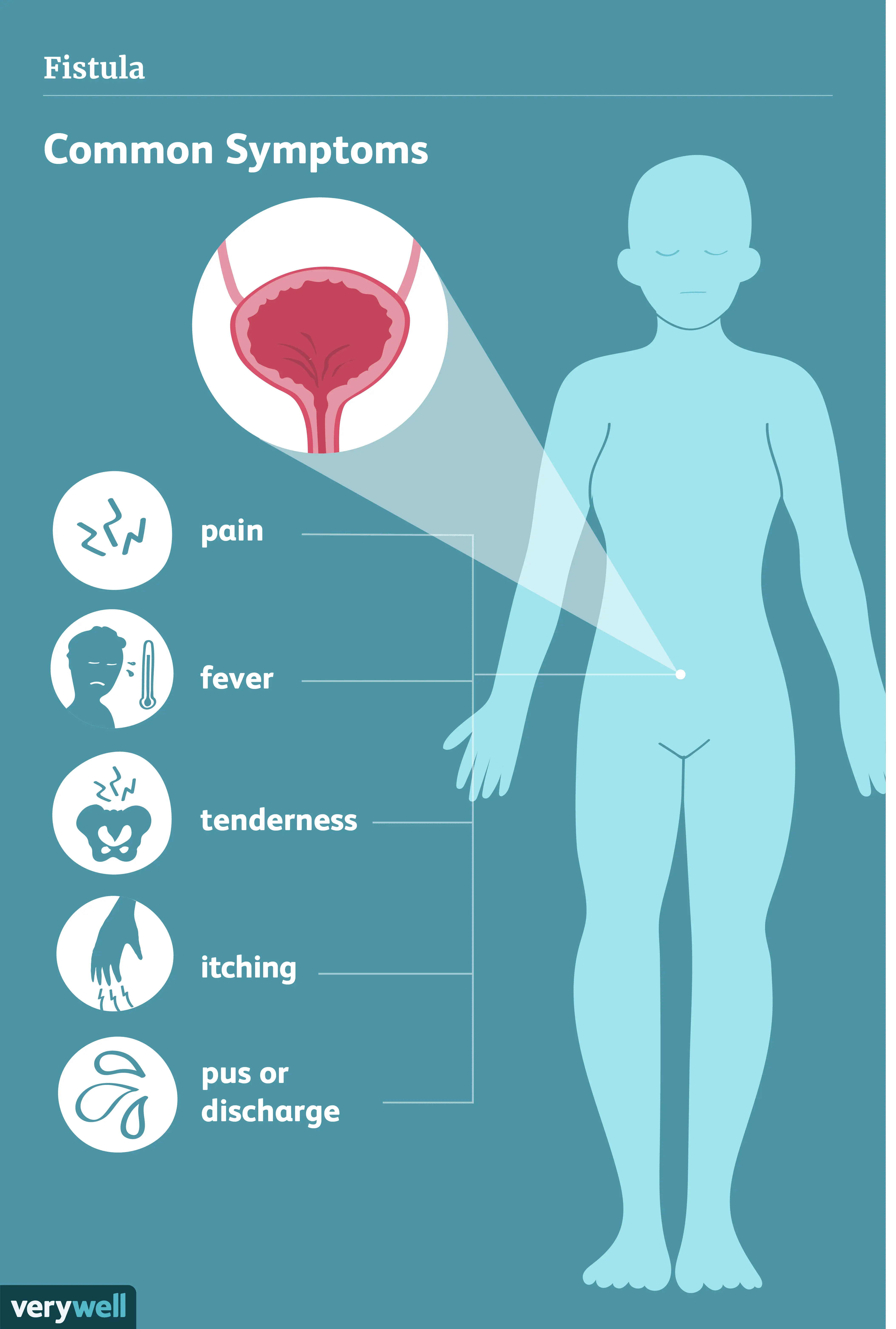 Anal fistula &#8211; causes, symptoms and diagnosis