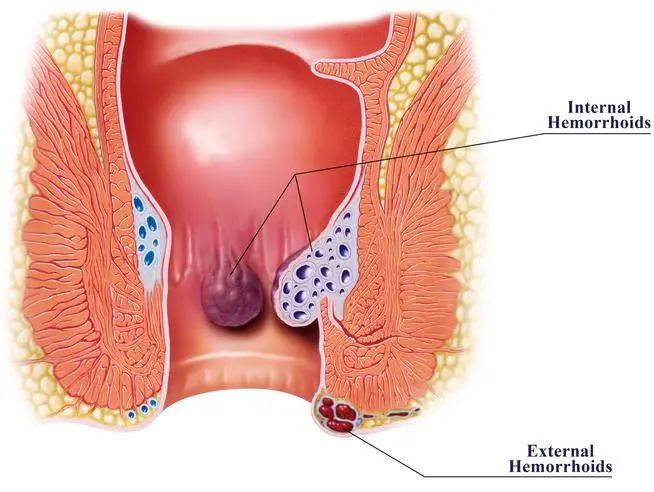 Anal sex &#8211; types, preparation, safety. Anal sex and sexually transmitted diseases