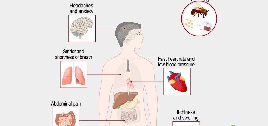 Anaphylactic shock &#8211; factors that can cause it. Symptoms of anaphylactic shock