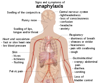 Anaphylactic shock