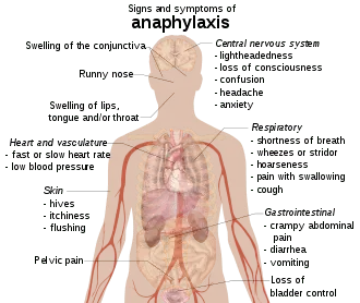 Anaphylactic shock