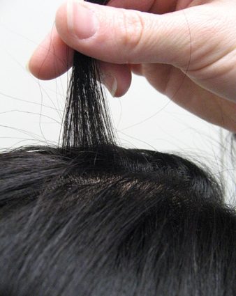 Androgenetic alopecia &#8211; causes, symptoms, diagnosis, treatment