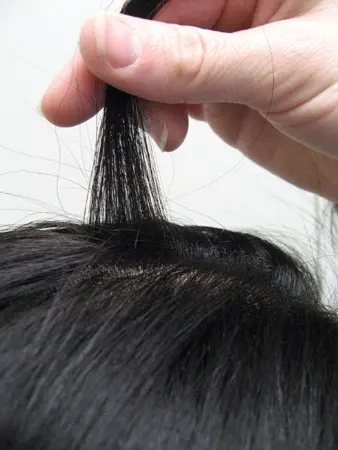 Androgenetic alopecia &#8211; causes, symptoms, diagnosis, treatment