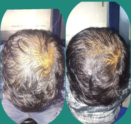 Androgenetic alopecia &#8211; how to treat it?