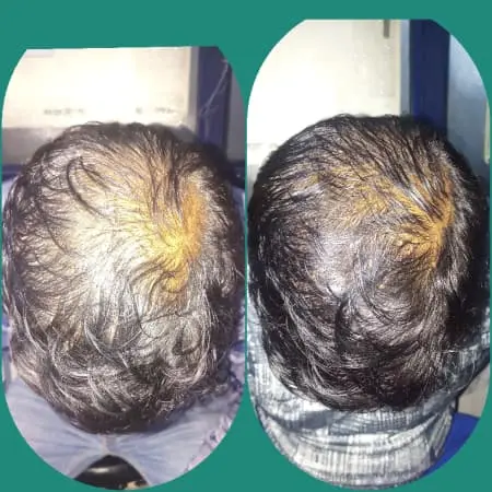 Androgenetic alopecia &#8211; how to treat it?