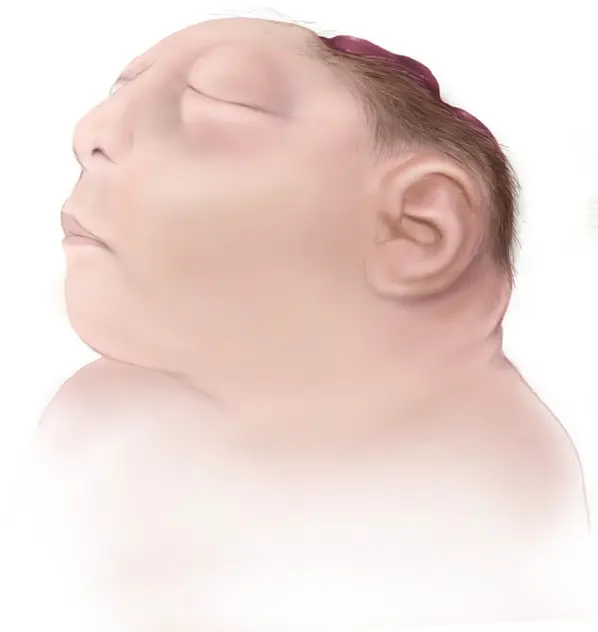 Anencephaly &#8211; diagnosis, prevention. Fatal birth defect