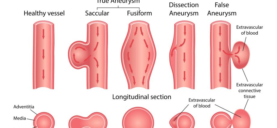 Aneurysm &#8211; types, causes, symptoms and treatment [WE EXPLAIN]