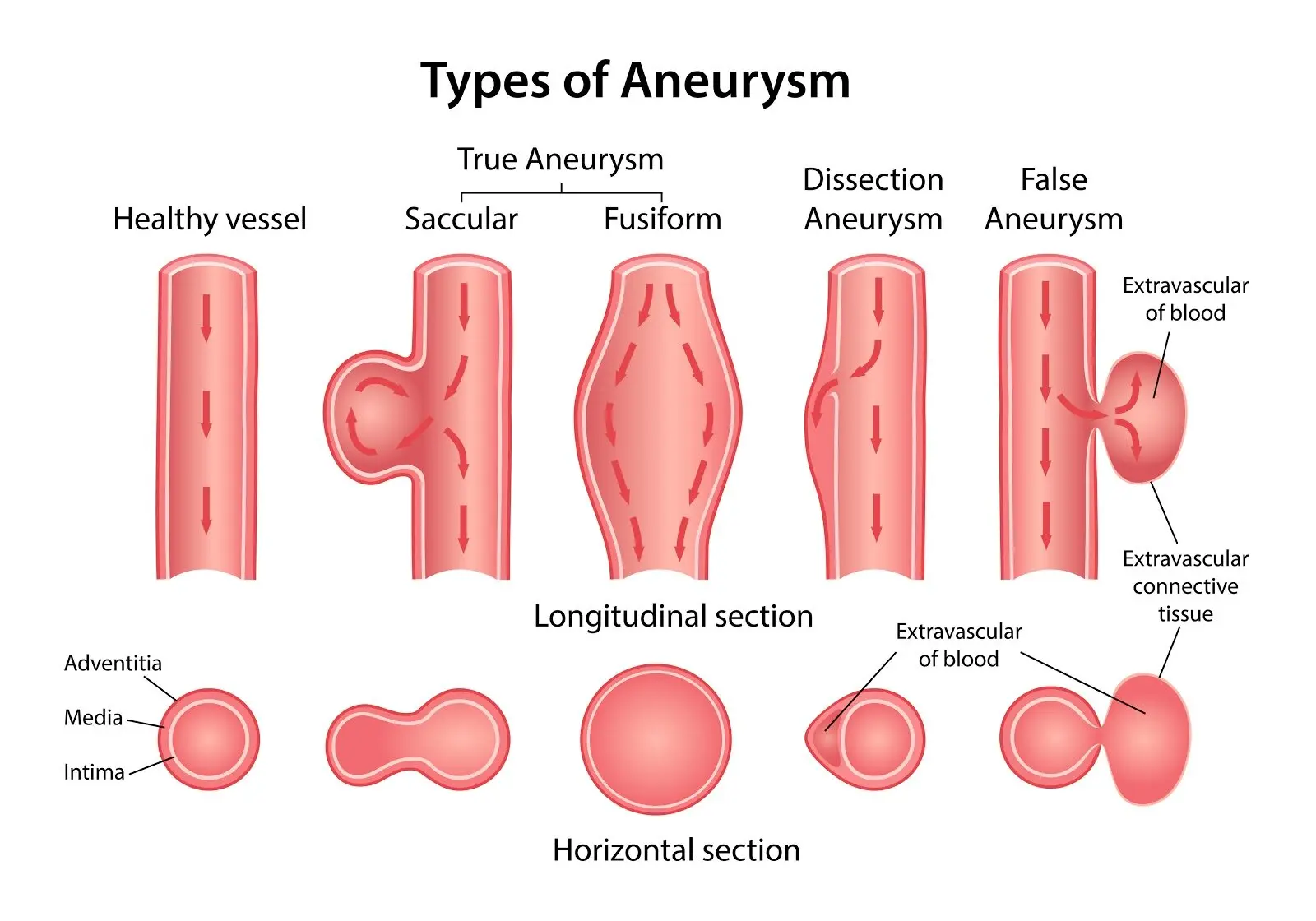 Aneurysm &#8211; types, causes, symptoms and treatment [WE EXPLAIN]