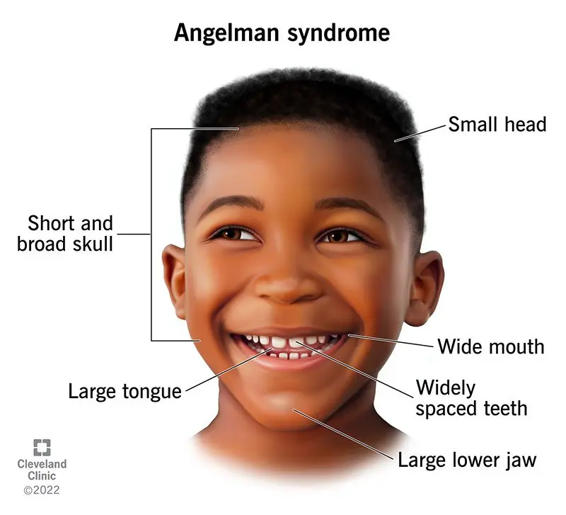 Angelman syndrome &#8211; symptoms, diagnosis, treatment, prognosis