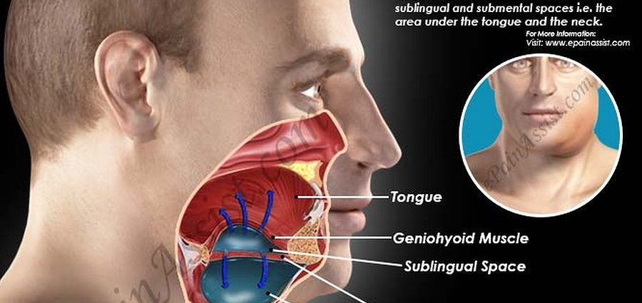 Angina in children &#8211; symptoms, causes, treatment