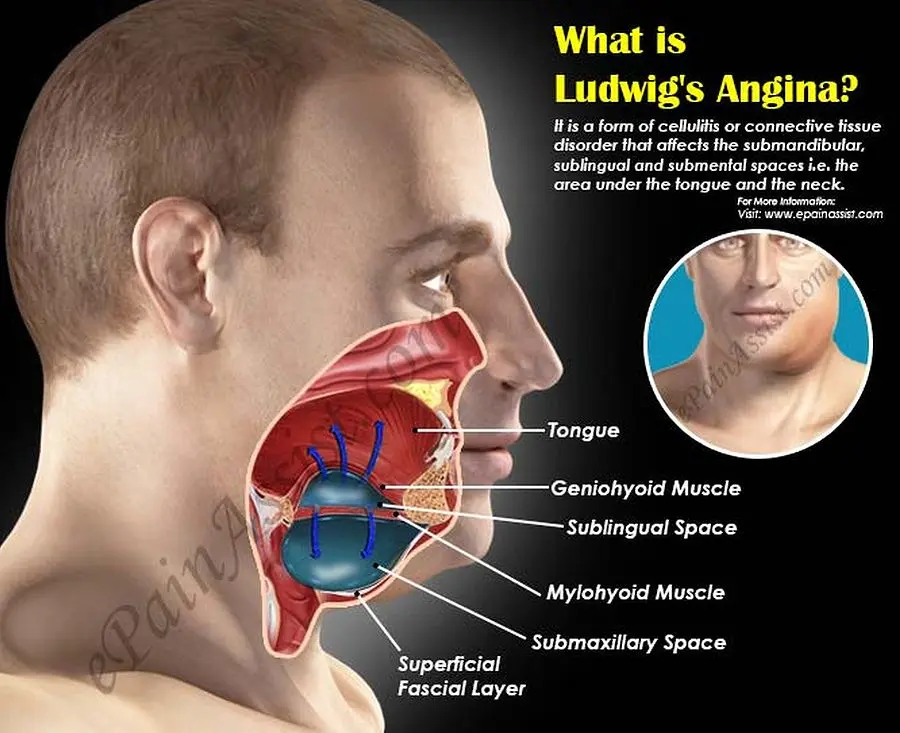 Angina in children &#8211; symptoms, causes, treatment