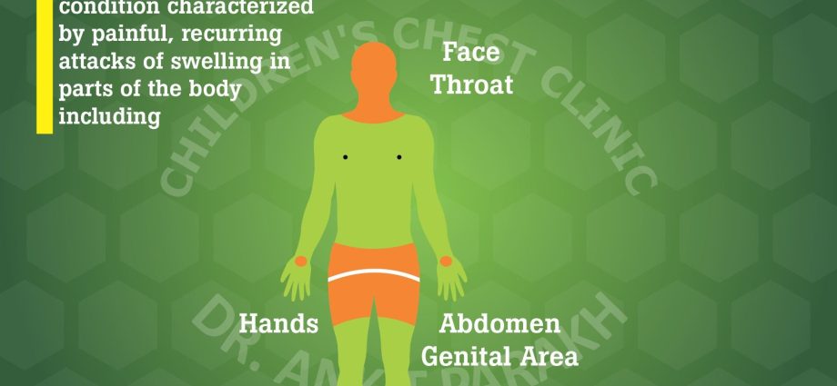 Angioedema &#8211; causes, types, symptoms, treatment, how to avoid