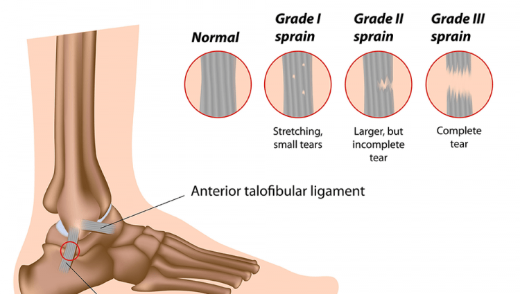 Ankle sprain &#8211; pain that persists after healing