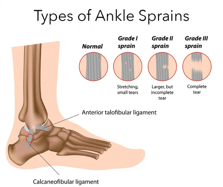 Ankle sprain &#8211; pain that persists after healing