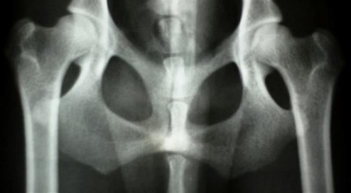 Another medical scandal on the Seine: problematic hip prostheses