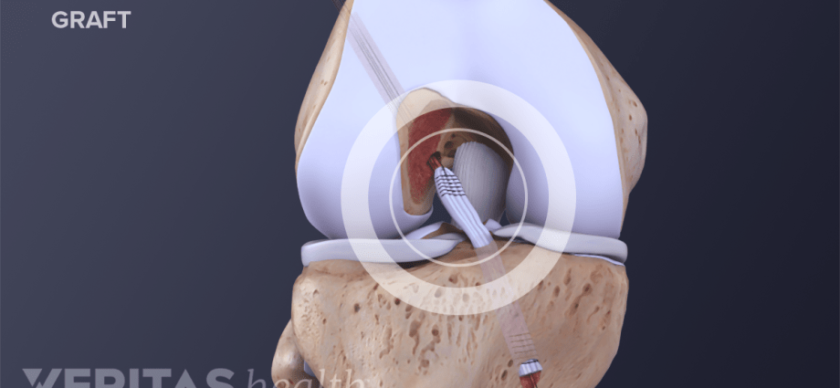 Anterior cruciate ligament &#8211; how to treat? Knee ligament reconstruction