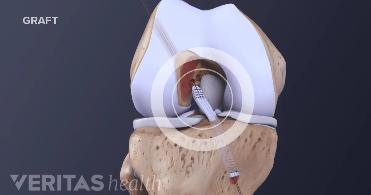 Anterior cruciate ligament &#8211; how to treat? Knee ligament reconstruction