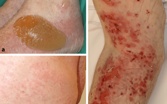 Anti-p200 pemphigoid