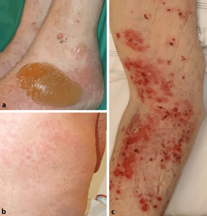 Anti-p200 pemphigoid