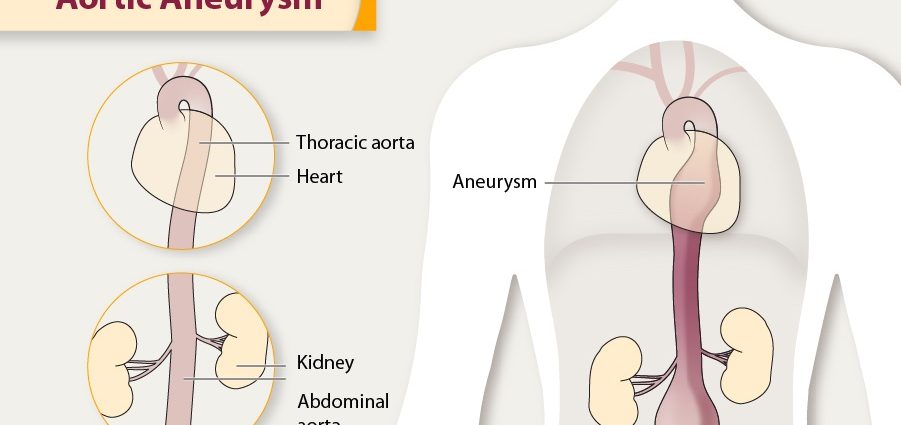 Aortic aneurysm &#8211; causes, types, symptoms, treatment. How is an aortic aneurysm diagnosed?