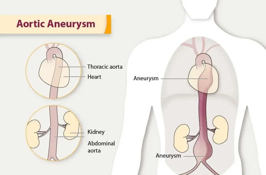 Aortic aneurysm &#8211; causes, types, symptoms, treatment. How is an aortic aneurysm diagnosed?