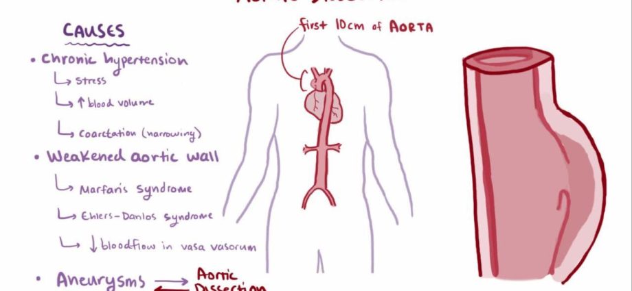 Aortic dissection &#8211; causes, symptoms