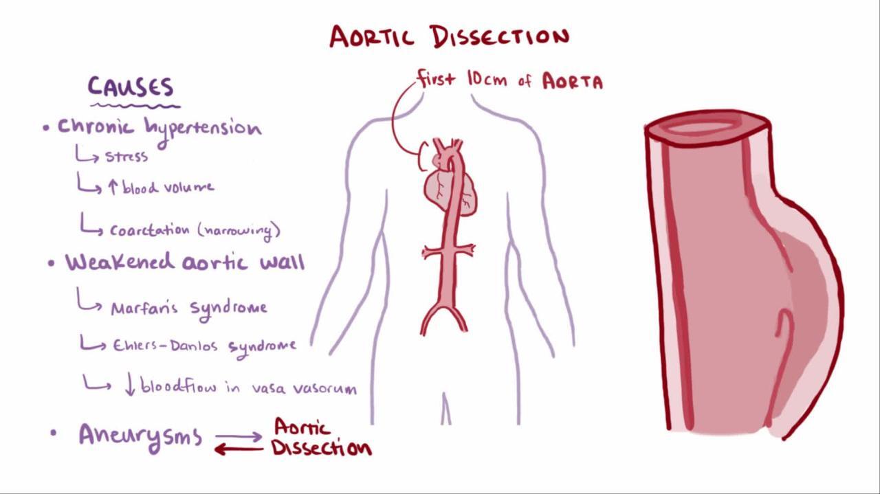 aortic-dissection-causes-symptoms-healthy-food-near-me