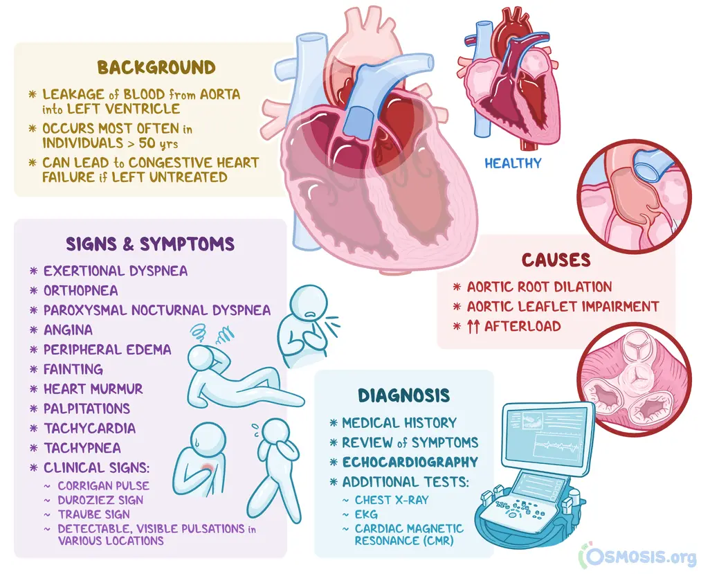 Aortic regurgitation &#8211; causes, symptoms, treatment