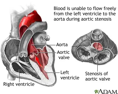 Aortic stenosis