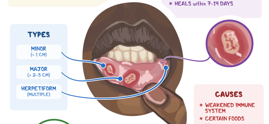 Aphthous on the tongue &#8211; causes and treatment of aphthous stomatitis. How to prevent canker sores?