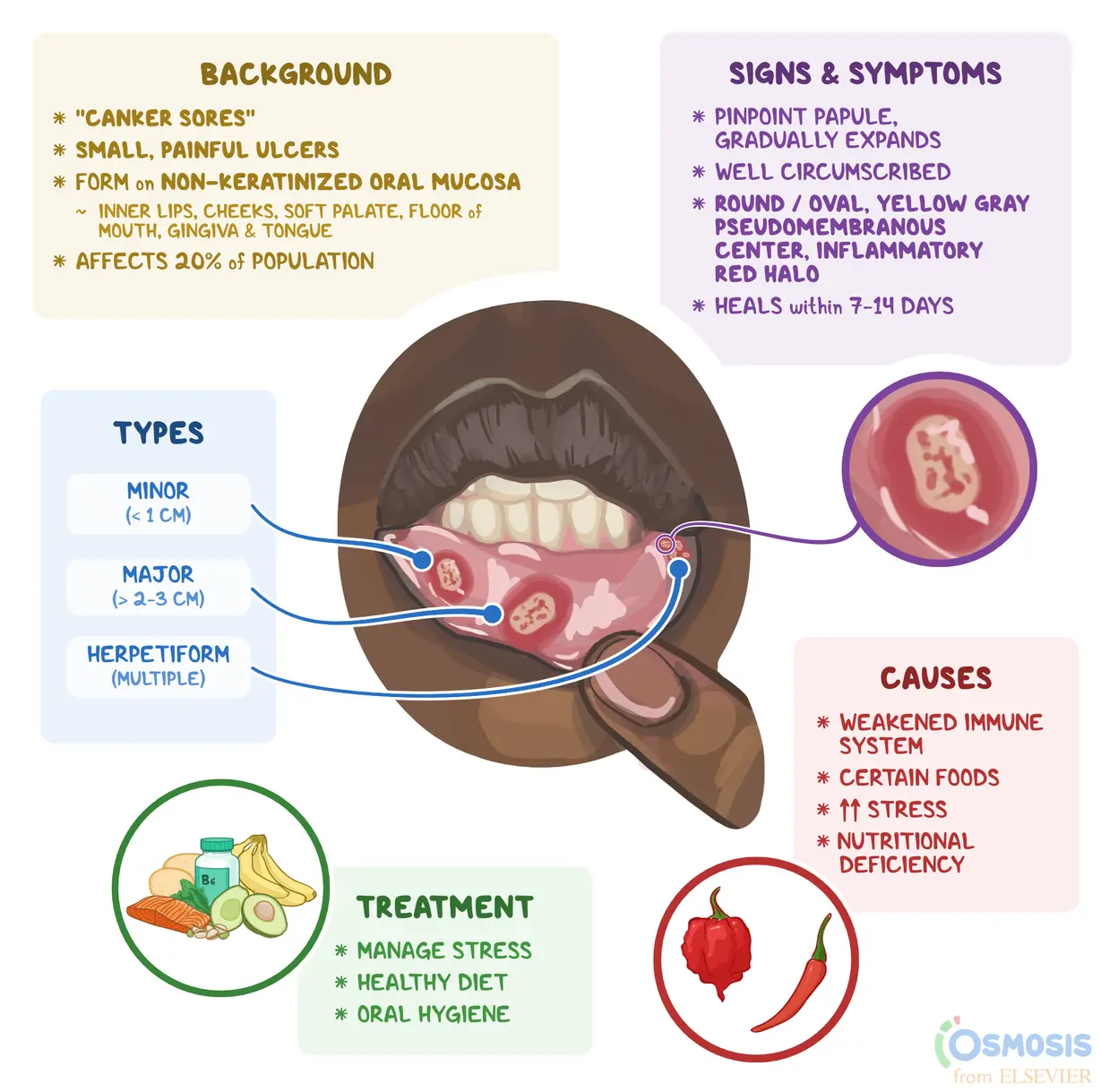 Aphthous on the tongue &#8211; causes and treatment of aphthous stomatitis. How to prevent canker sores?