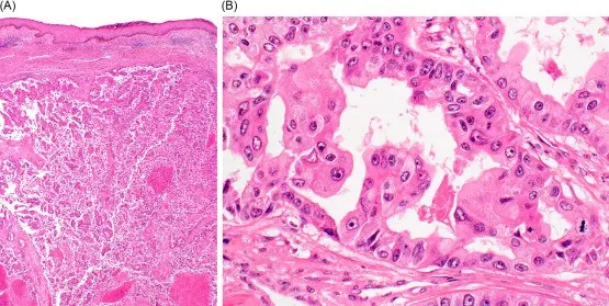 Apocrine cancer &#8211; what are malignant tumors of sweat glands?