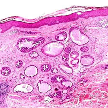 Apocrine tubular adenoma