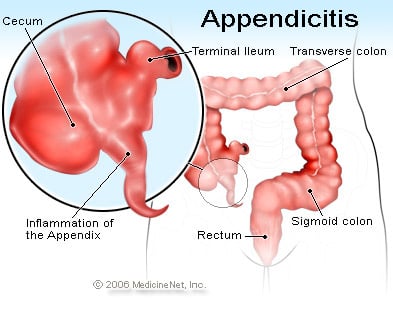 Appendicitis &#8211; causes, symptoms, treatment and complications. What does appendectomy look like? [WE EXPLAIN]