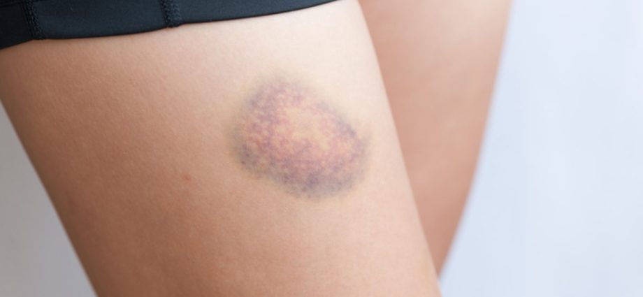 Are bruises and spider veins a harbinger of varicose veins?