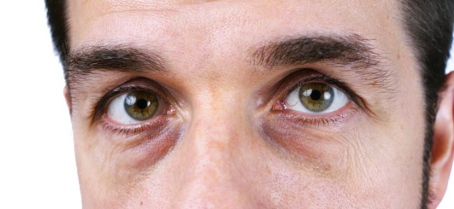 Are dark circles under the eyes a symptom of a disease?