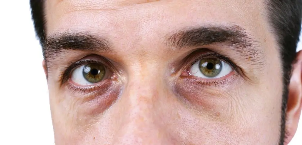 Are dark circles under the eyes a symptom of a disease?