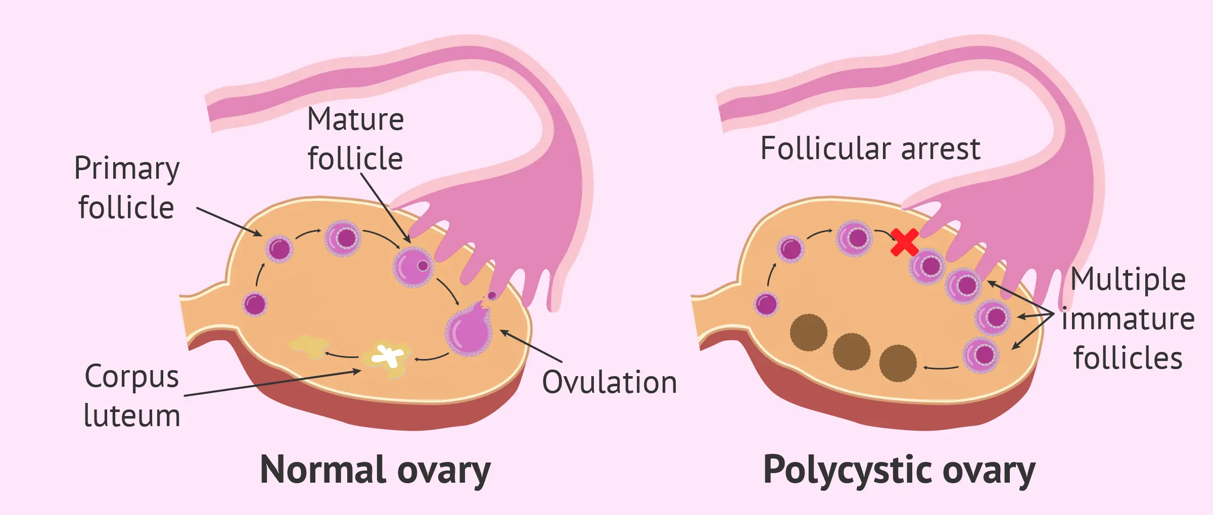 Are follicles on the ovaries a symptom of PCOS?