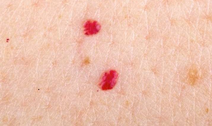 Are red moles dangerous?