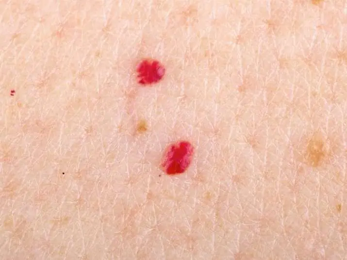 Are red moles dangerous?