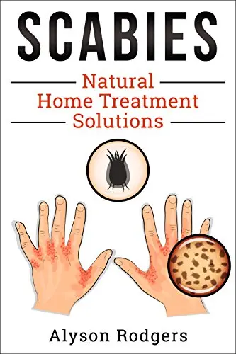 Are there home treatments for scabies?