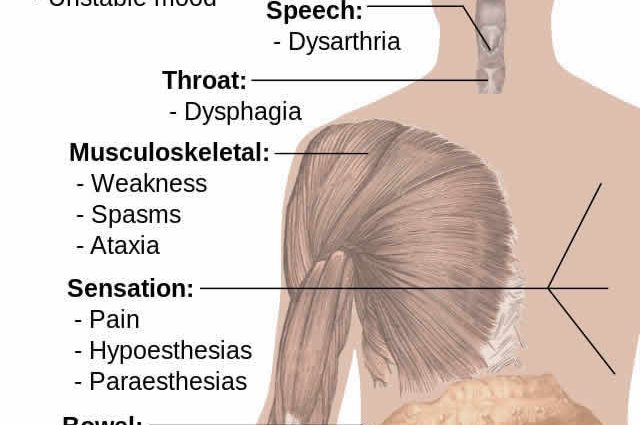 Are we witnessing a breakthrough in the treatment of multiple sclerosis?