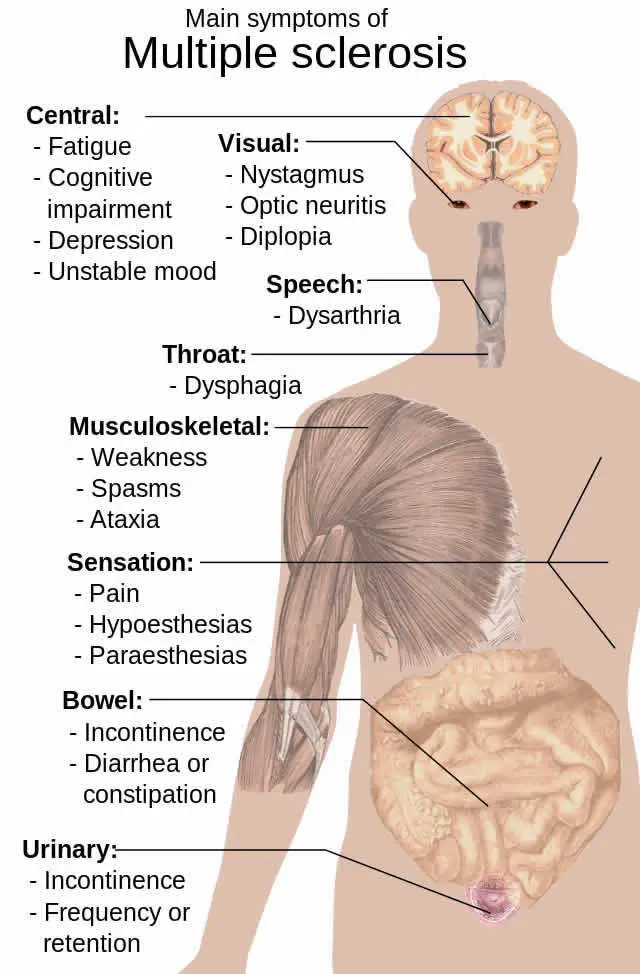 Are we witnessing a breakthrough in the treatment of multiple sclerosis?