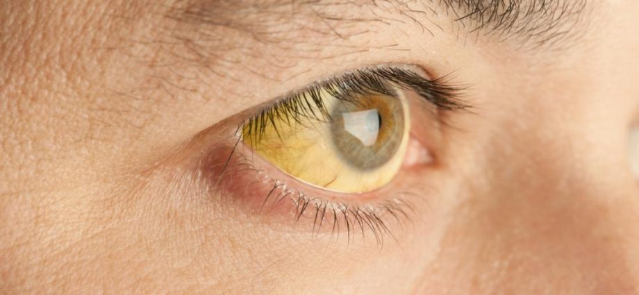 Are yellow eyes a symptom of a disease?