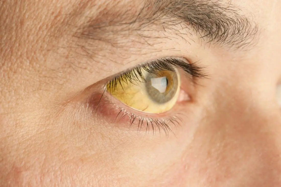 Are yellow eyes a symptom of a disease?